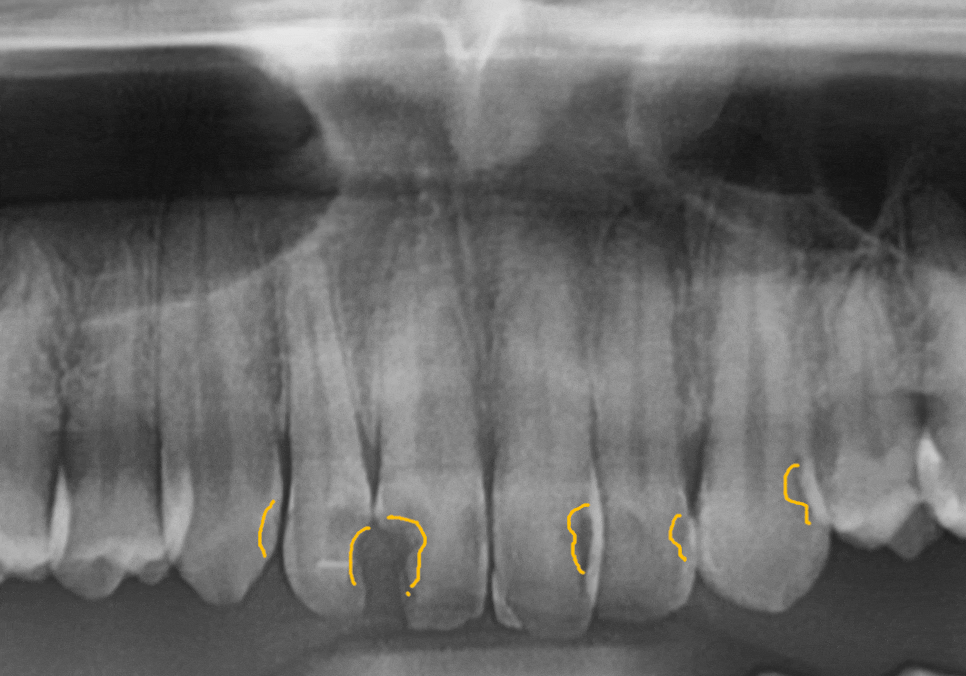 A Single Black Spot of Decay Between the Front Teeth May Be a Warning Sign of Multiple Cavities. image 1