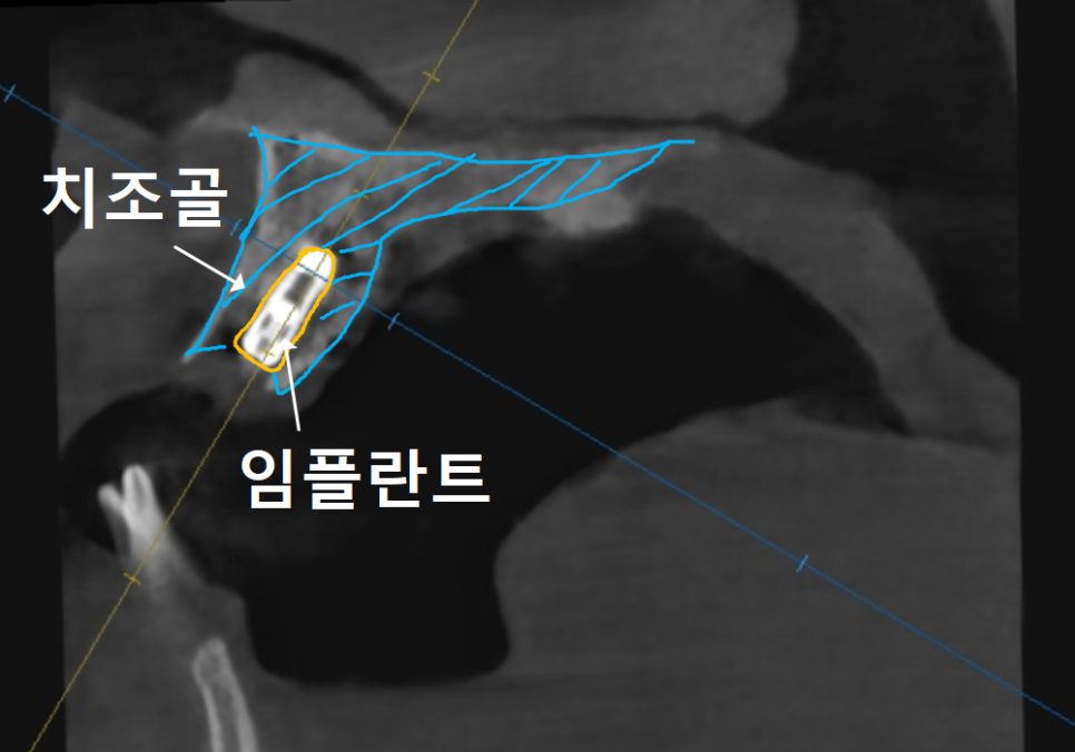 위 턱 전체 임플란트 vs 부분 틀니, 나에게 꼭 필요한 치료법 찾기 관련 이미지 12