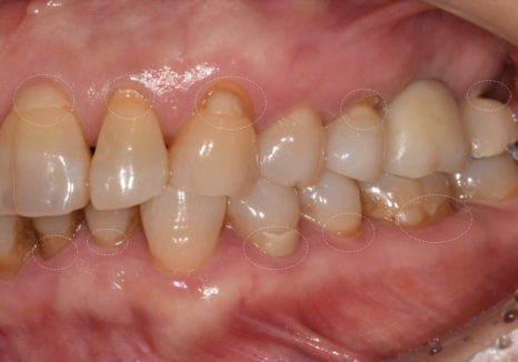 대문니 파절, 앞니에 금이 쩍 갈라졌다면? 딱딱한 음식을 조심해야 하는 이유 관련 이미지 8