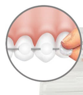 길동 치아교정 통증 겪어보지 않았기에 어느정도일까? 관련 이미지 5