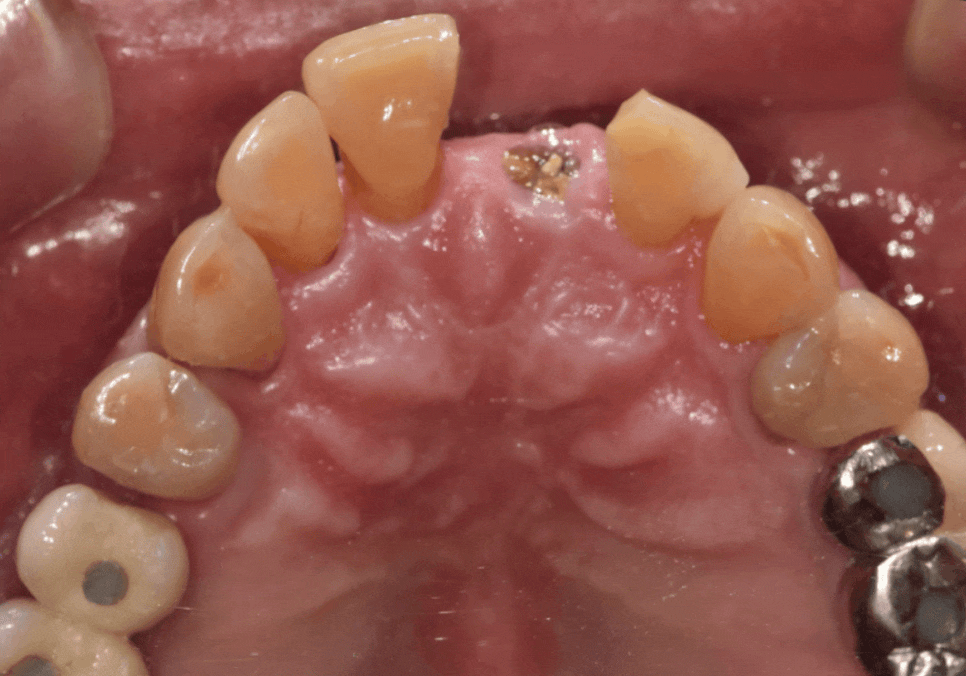 상일동역 치과 앞니 임플란트 기간 때문에 망설이신다면 꼭 보세요. 관련 이미지 8