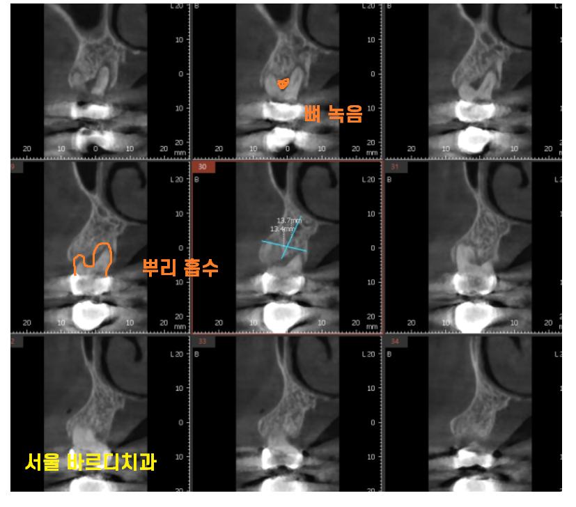 풍산동 치과 임플란트 시술후 통증 부작용은 아닐까? 관련 이미지 6