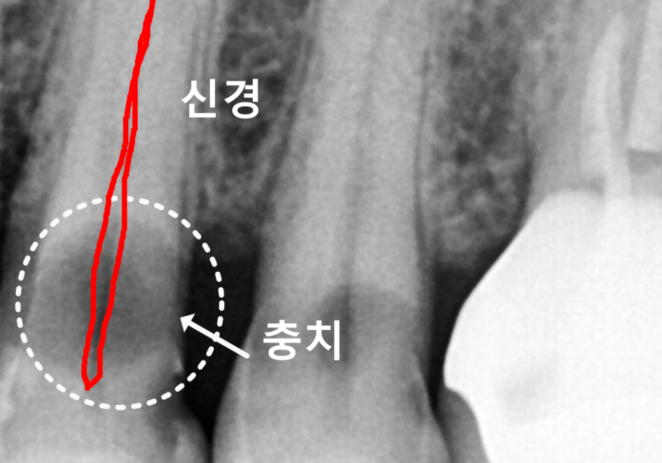 치아 뿌리 충치, 왜 다른 부위보다 위험하다고 하는 걸까? 관련 이미지 5