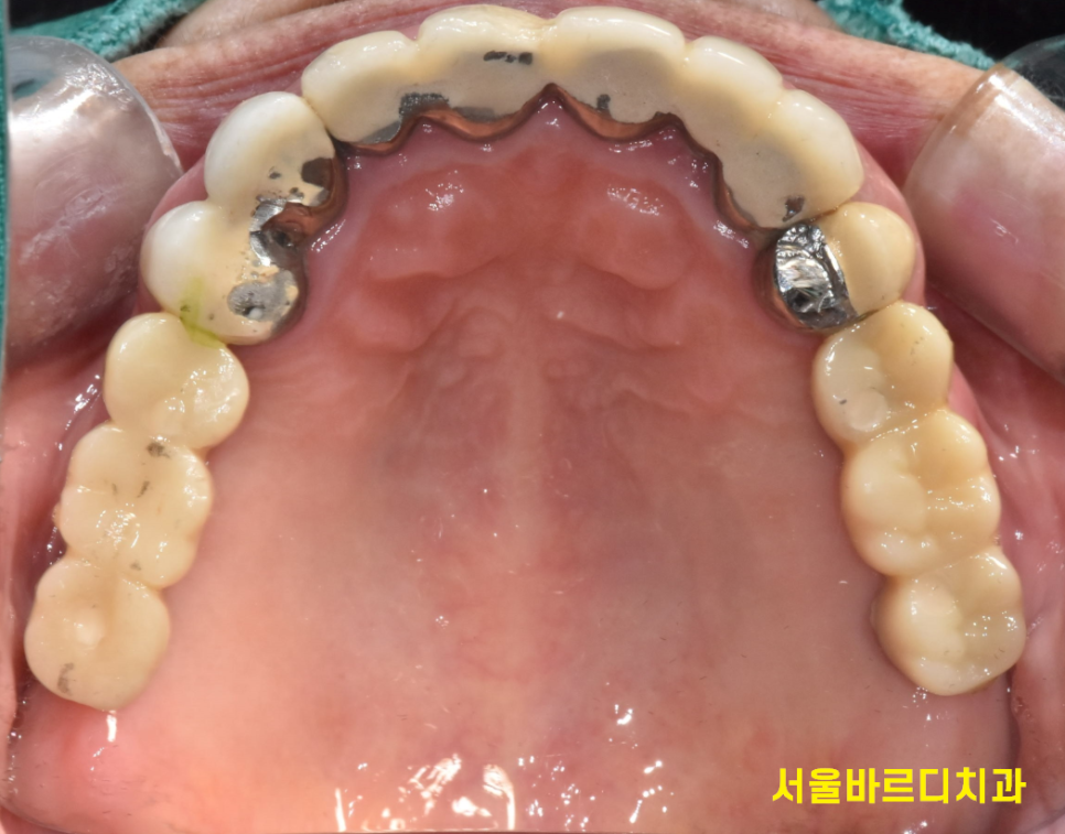 하남 임플란트 치과 주문진에서부터 치료 받으러 오신 환자분 관련 이미지 11