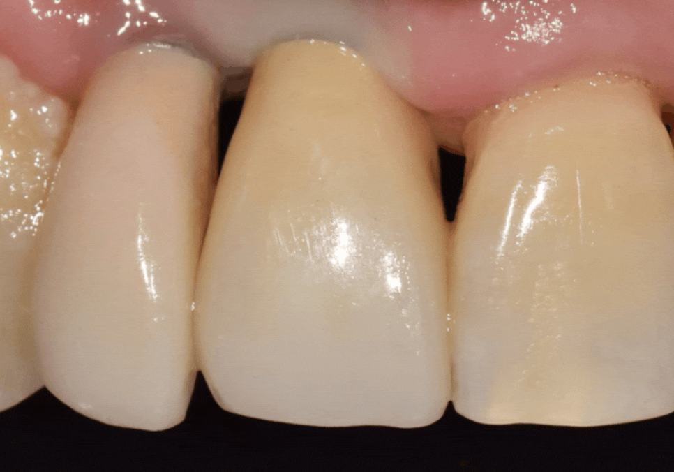 앞니 임플란트, 원내 기공소의 중요성을 아시나요? 관련 이미지 19