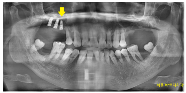 길동 치과 임플란트 뼈이식 후 흡연 상관 있을까? 관련 이미지 6