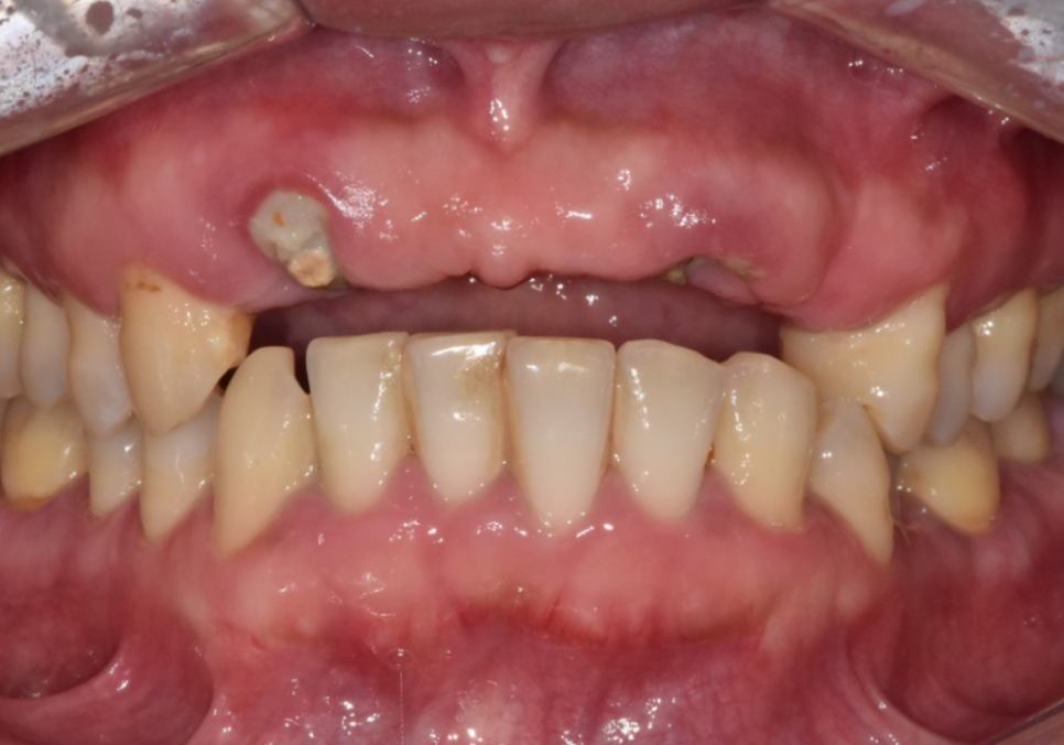 앞니 브릿지 부러짐, 이런 상태라면 절대 브릿지 다시 하지 마세요. 관련 이미지 4