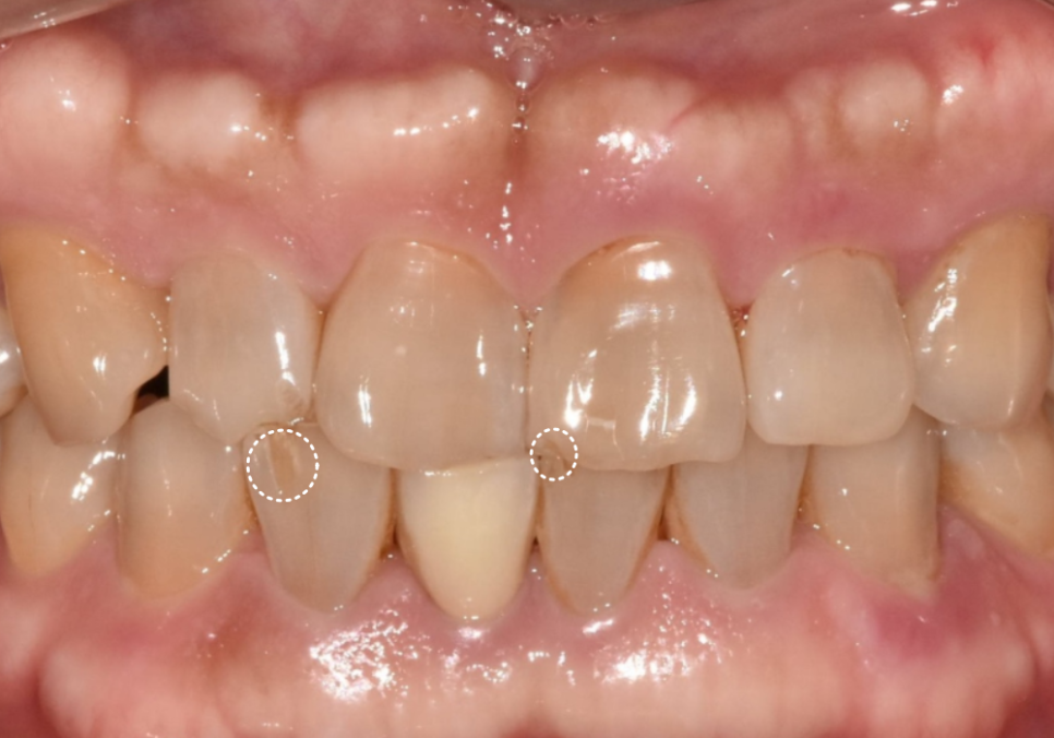 앞니 깨짐 치료 비용, 더이상 치과에 돈 낭비하기 싫다면? 깨지는 원인부터 알아야 합니다. 관련 이미지 5