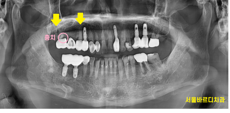 고덕동 치과치료 씌운 치아 문제가 생겼어요 관련 이미지 2