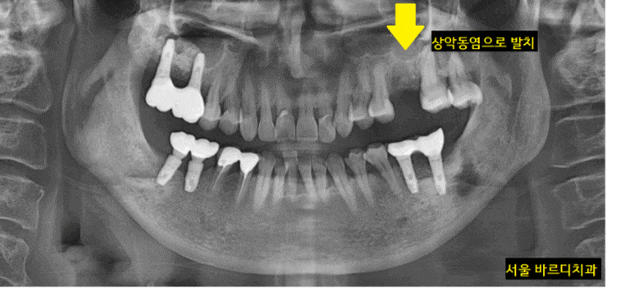 미사역 임플란트 상악동염으로 치아를 발치한 사연 관련 이미지 1