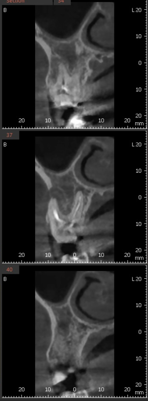 발치 대신 신경치료 뽑기 전 치료는 한번 해봐야하지않을까요? 관련 이미지 10