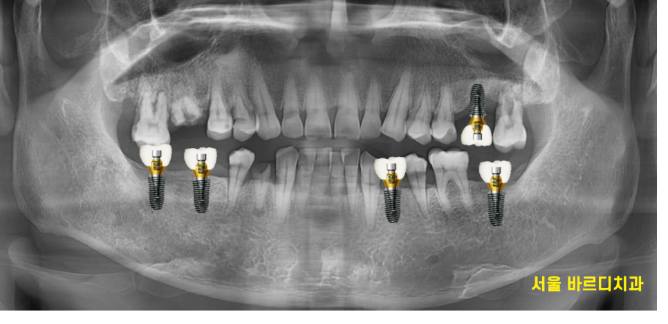 망월동 치과 어금니 빠짐 임플란트 대안이 될 수 있습니다. 관련 이미지 2