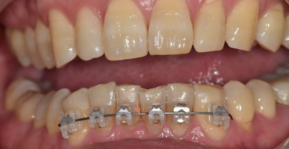 교정 철사 교체 와이어 왜 자꾸 갈까? 주기는? 관련 이미지 4