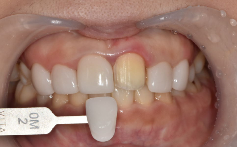 라미네이트 깨짐 원인 TOP 3, <대표원장>이 직접 알려드립니다 관련 이미지 5