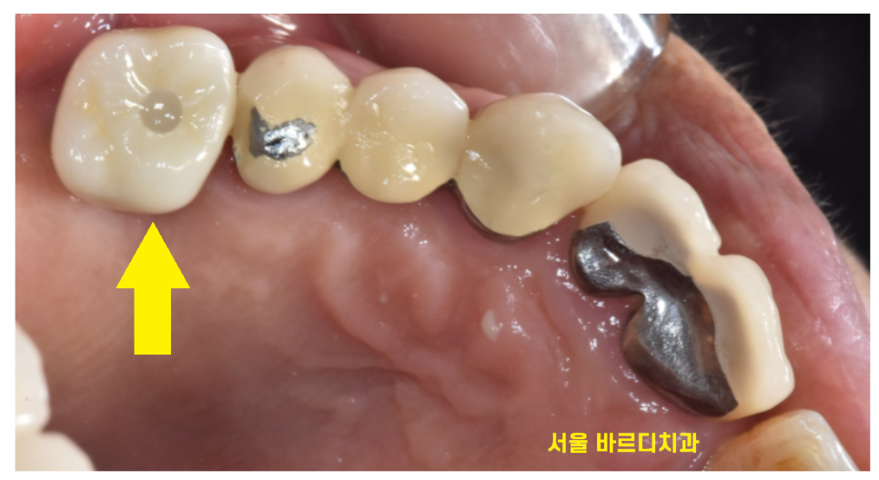 암사동 치과 골다공증 치료 중 임플란트 가능한가요?? 관련 이미지 10