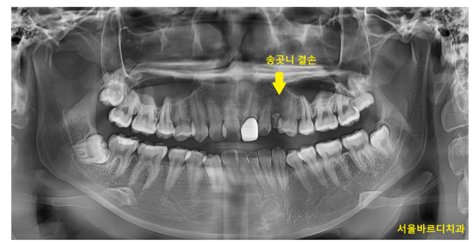 치아 중심선 안맞을 때 걱정스러우신 분들이라면? 관련 이미지 4