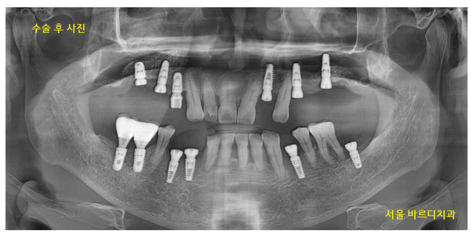 하남시청치과 디지털 임플란트를 고집하는 이유 관련 이미지 11