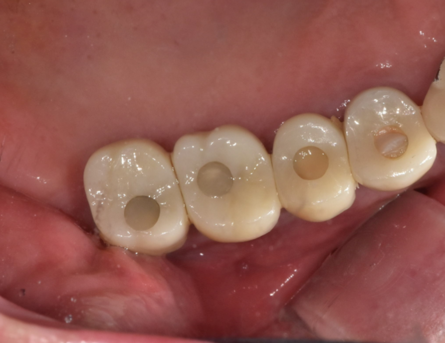 고덕동 치과치료 씌운 치아 문제가 생겼어요 관련 이미지 9