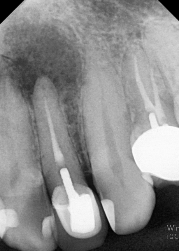 강동구 재신경치료, 왜 첫 치료보다 성공률이 낮다고 할까요? 관련 이미지 7