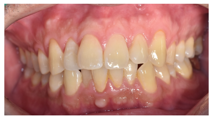 고덕동 교정 치과 성인 덧니 교정 지금도 늦지 않았습니다. 관련 이미지 3