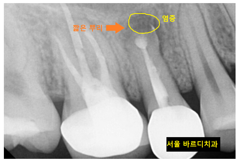 망월동 치과 재신경치료 자연치아 살리기 끝판왕 치료 mta로 가능했습니다. 관련 이미지 3