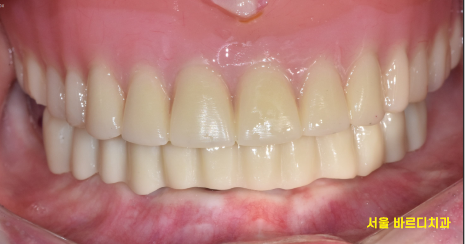 상일동 근처 치과 얇은뼈 틀니 안될 때 해결 방법은?? 관련 이미지 11