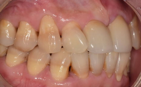 잇몸 내려감으로 길어진 치아, 방치하면 안 되는 원인, 증상, 이유 관련 이미지 13