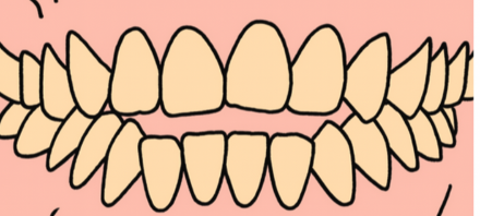 앞니 안물림 면을 끊어먹지 못하는 개방교합 치료가 시급합니다. 관련 이미지 3