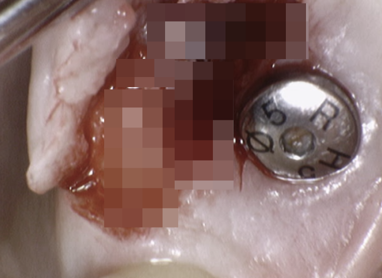 Can I Take a Plane After a Tooth Extraction? Dental Knowledge Patients Should Know Before Traveling image 2