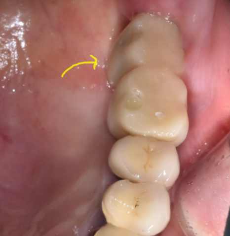 위아래 임플란트 동시에 하여 치료기간 단축하기 관련 이미지 11