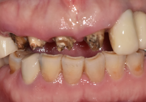 앞니 브릿지 탈락, 씌워둔 게 빠졌어요. 다시 붙일 수 있을까요? 관련 이미지 7