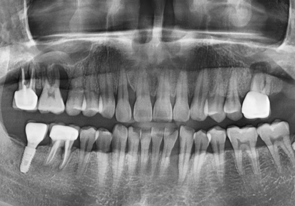 상악동 거상술 부작용 걱정되시나요? 재수술 없는 뼈이식의 정석 공개 관련 이미지 4