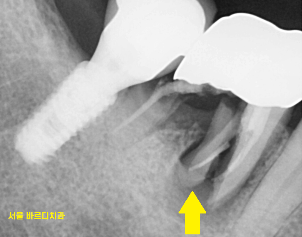 암사동 치과 치아 뿌리 균열 금 갔을 때 임플란트 치료로 행복해지세요. 관련 이미지 3