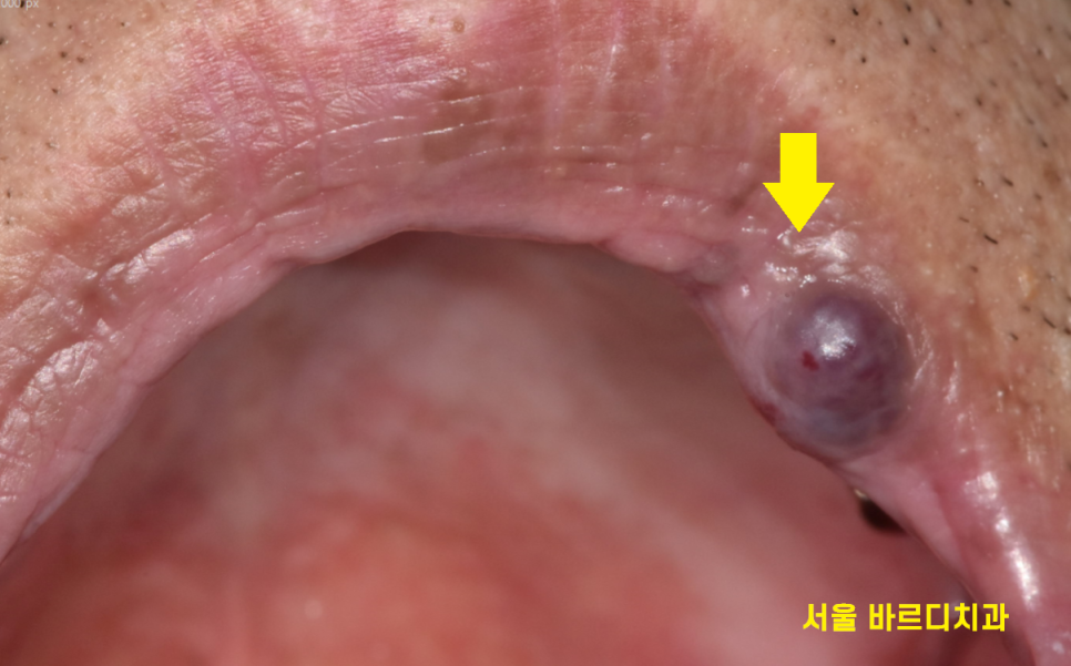 입술 혹 씹었을때 부풀고 딱딱 하다면 간단히 제거하세요 관련 이미지 3