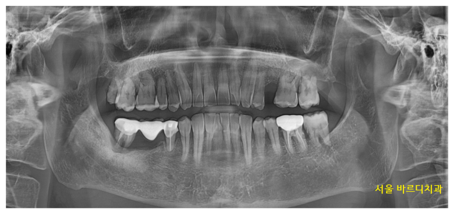 강일역 치과 치아와 임플란트 연결 가능한가요??? 관련 이미지 2