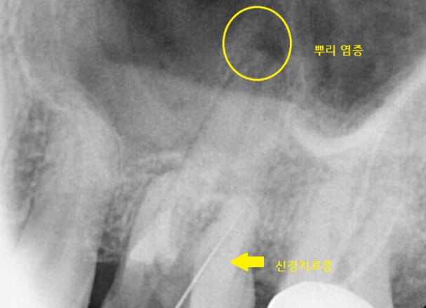 상일동치과 비가역적 치수염 치아 심폐소생했습니다. 관련 이미지 5