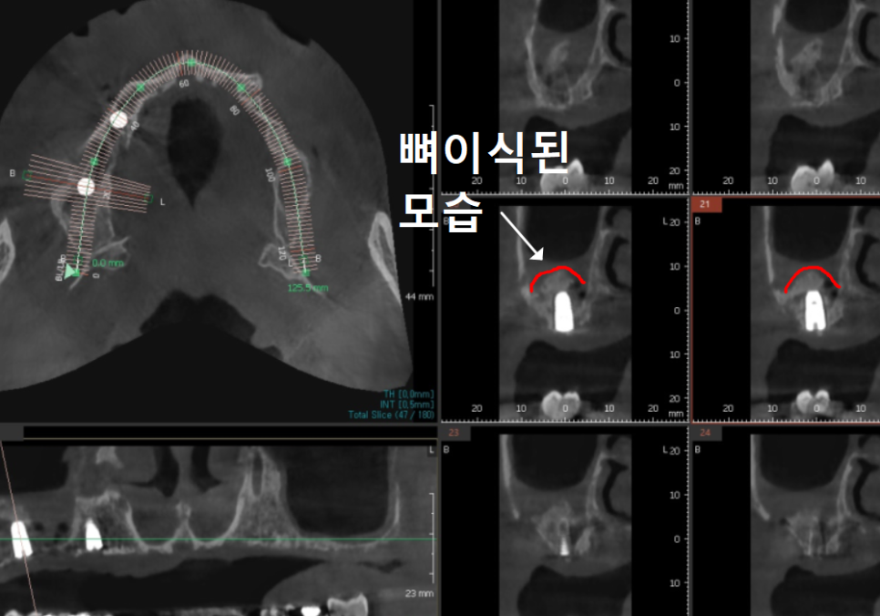 뼈가 없어서 안 된다구요? 70대 당뇨 무치악 환자분의 전체 임플란트 사례 관련 이미지 12
