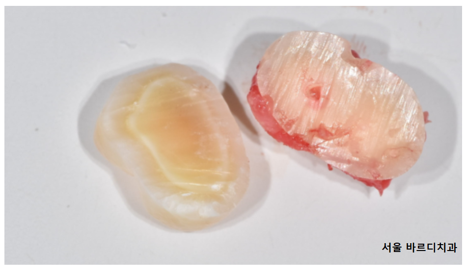 덕풍동 치과 교정 치료 위해 숨어있는 매복치 수술 발치 문제없습니다 관련 이미지 7