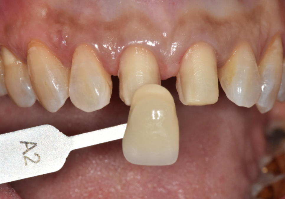 고덕동 치과 누런 이, 앞니 사이 틈, 잘못된 관리 때문일까? 관련 이미지 13