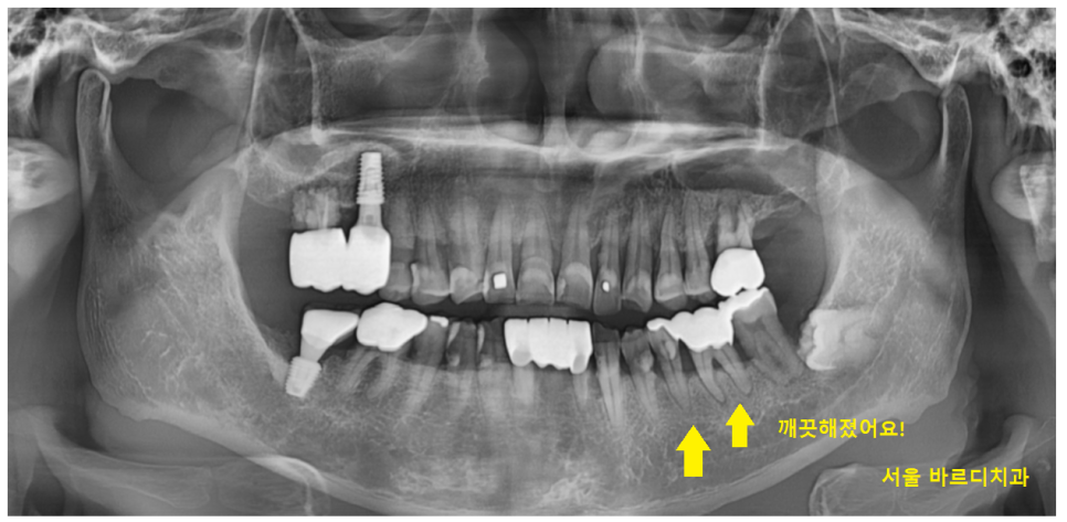 상일동역 스케일링 치과 잇몸치료 받아야하는 이유 필독! 관련 이미지 7
