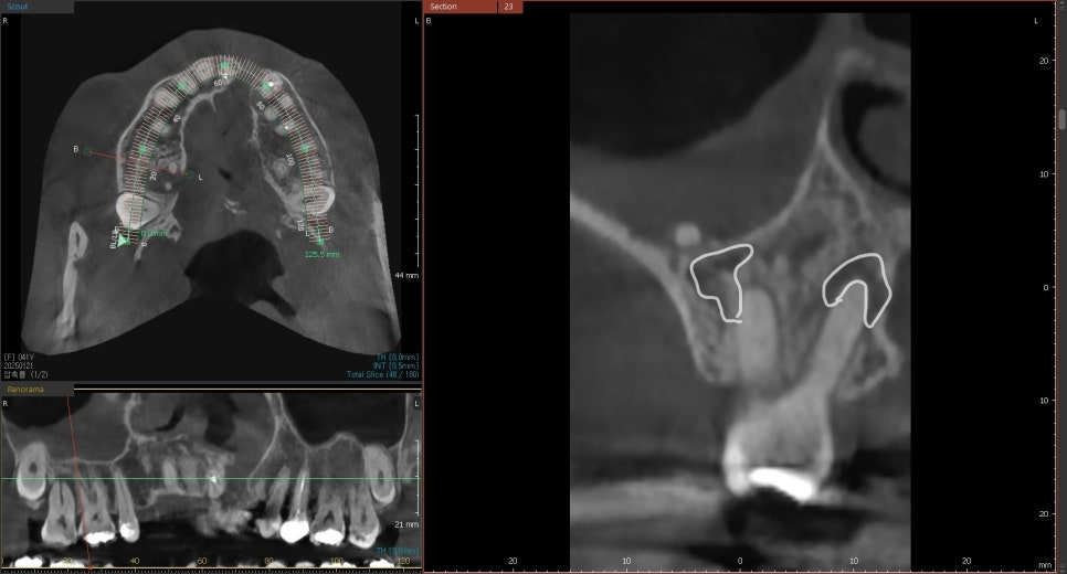 치아 뿌리 염증 빼야 된다는 치아, 이렇게 살렸습니다. 치료 방법 관련 이미지 3