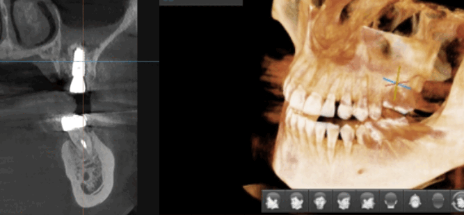 디지털 임플란트 체계적인 수술이 가능한 서울바르디치과입니다. 관련 이미지 2