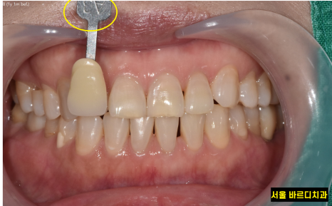 상일동 치아 미백 결혼 전 받아야하는 이유 3가지 관련 이미지 5
