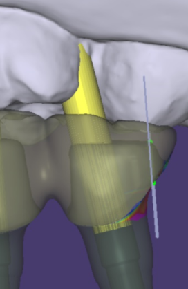 길동 치과 임플란트 2차 수술이요? 예전에 했잖아요 관련 이미지 6
