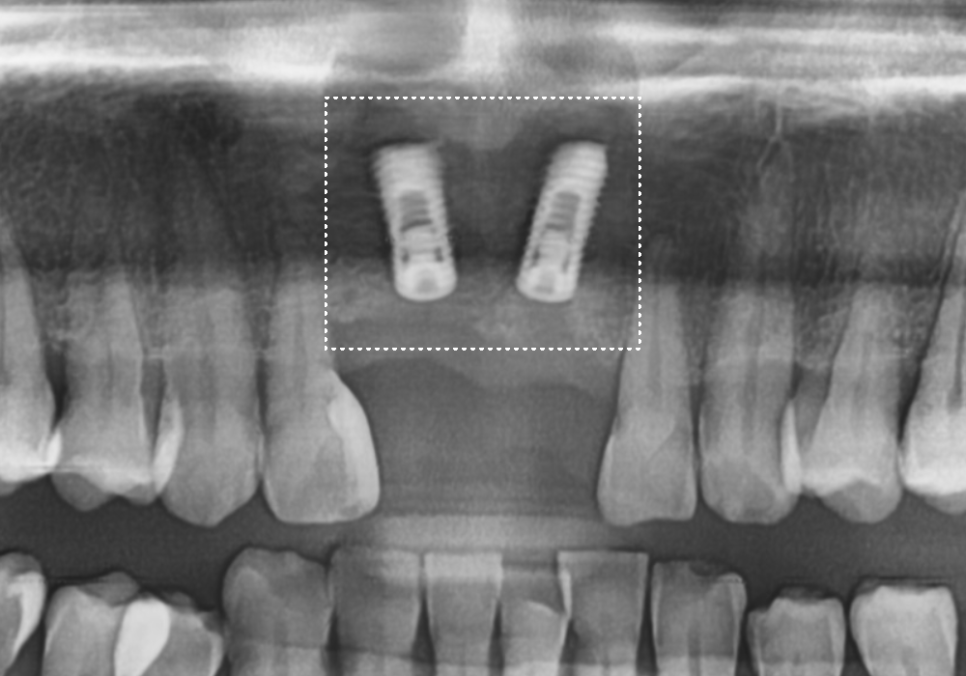 대문니 빠짐, 앞니 빠졌을 때 브릿지와 임플란트 중 나에게 맞는 선택은? 관련 이미지 9