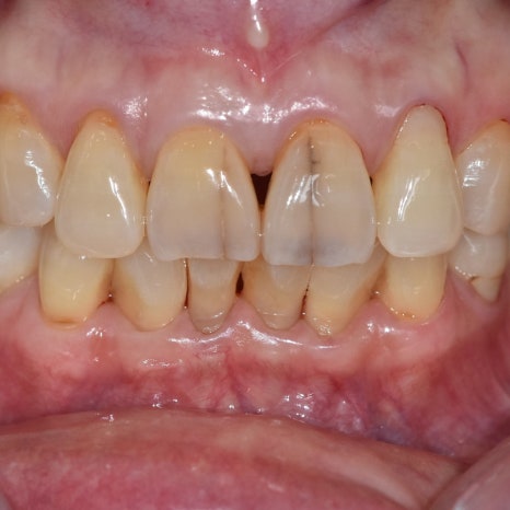 No-Prep Veneers: Do They Really Involve No Tooth Shaving? The 3 Questions Patients Ask Most image 5