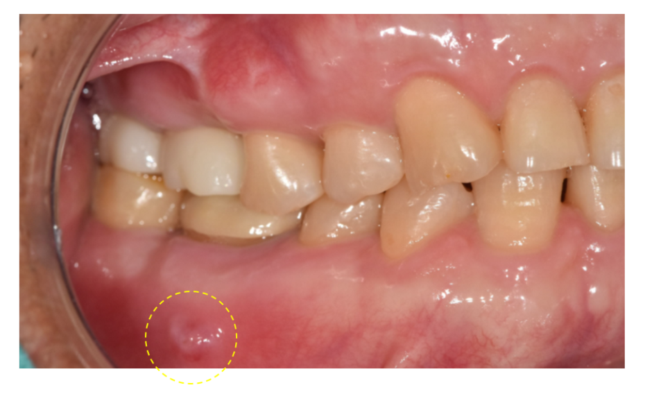 Implant treatment is needed when a gum pimple or pus appears. image 2