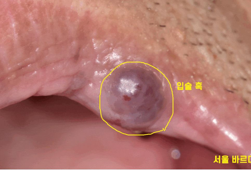 입술 혹 씹었을때 부풀고 딱딱 하다면 간단히 제거하세요 관련 이미지 1