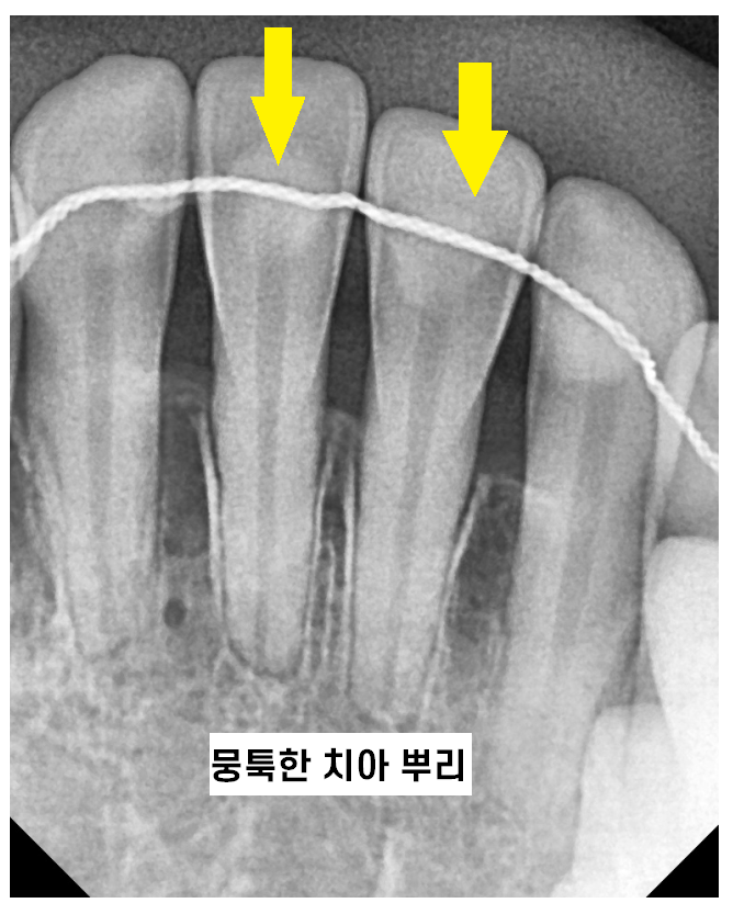 치아교정 치아 뿌리 짧아짐 치근 흡수 걱정이에요. 관련 이미지 3