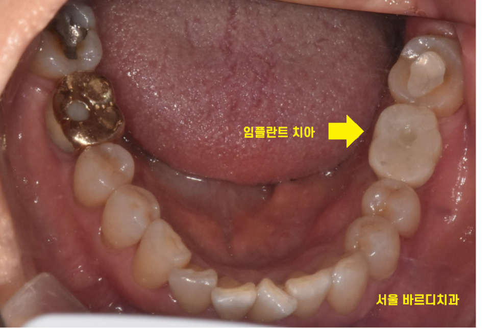 풍산동 치과 아래 어금니 임플란트 뼈 이식 없이 해결했습니다. 관련 이미지 8